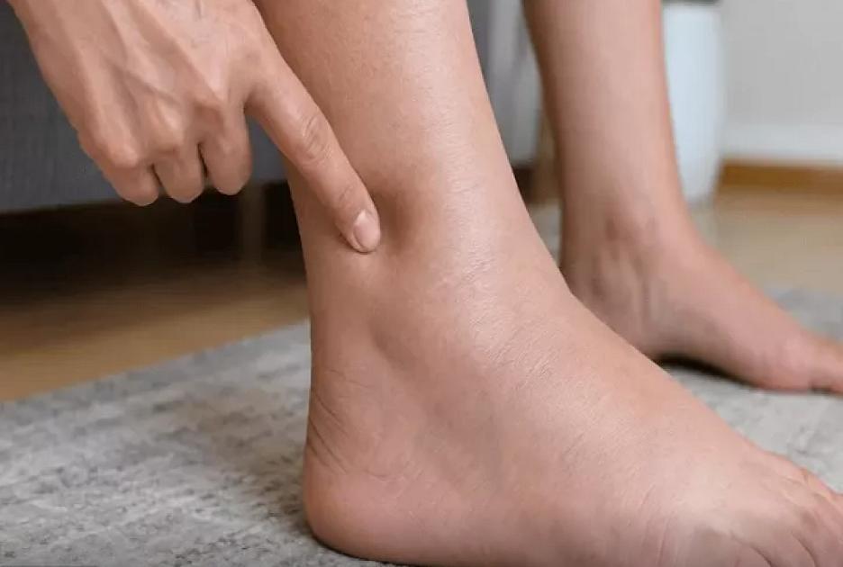Ayağınıza basanda çuxur qalır? -