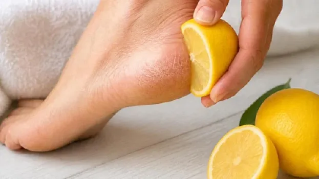 Dabanlarına limon çəkənlər bu problemdən xilas olurlar