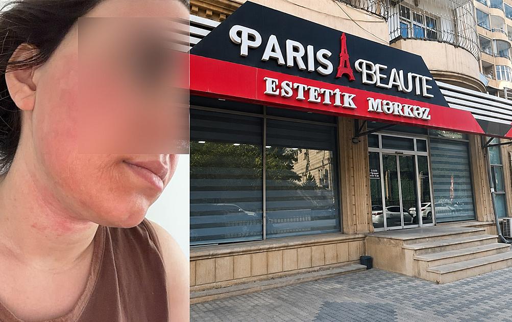 “Lazeroloq üzümü yandırıb...”