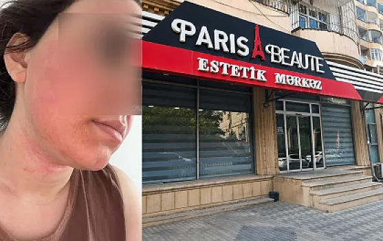 “Lazeroloq üzümü yandırıb...”