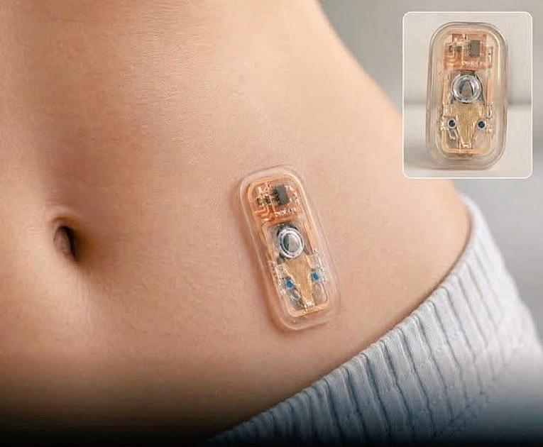 Mini "süni pankreas" hazırlanıb